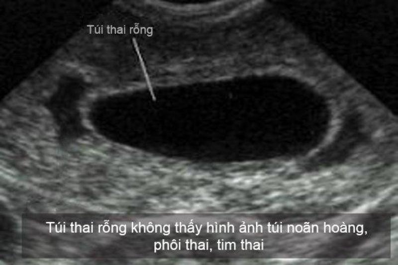 Hình ảnh siêu âm đầu dò âm đạo trong thai kỳ sớm để kiểm tra vị trí của túi thai trong tử cung